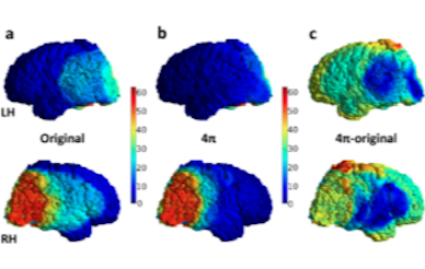 4pi brain radiotherapy graph