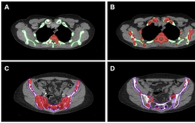 bone marrow radiation therapy stages