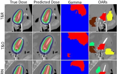 Neural network dose prediction for cervical brachytherapy