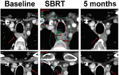 CT imaging of patient with SBRT