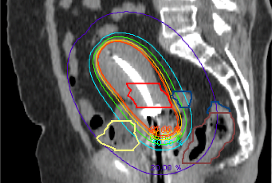 brachytherapy